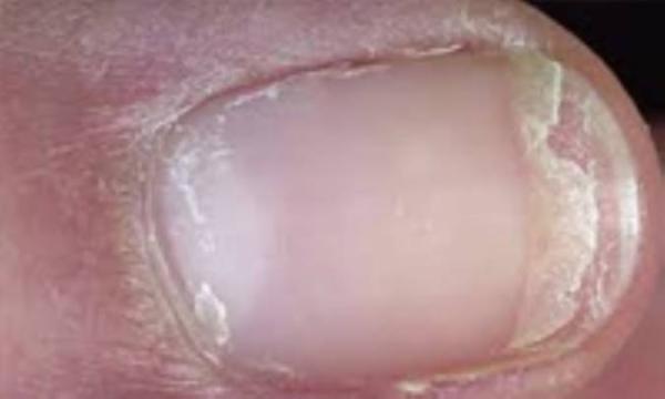 شکنندگی ناخن ها و ریزش مو